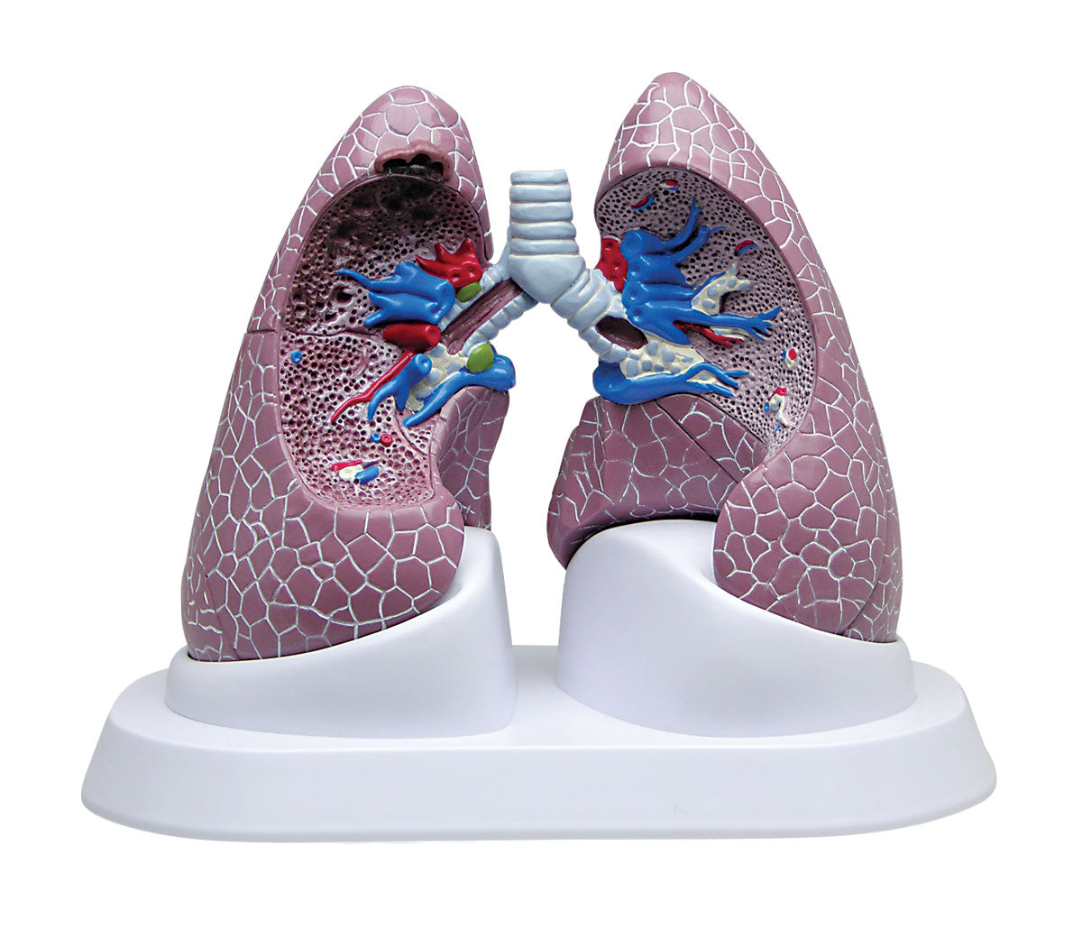 Model Lung Set With Pathologies