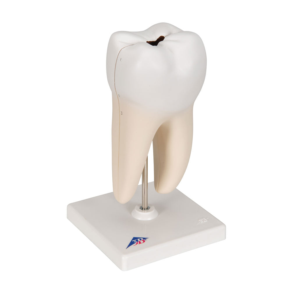 Lower Twin-Root Molar with Cavities Human Tooth Model, 2 Part