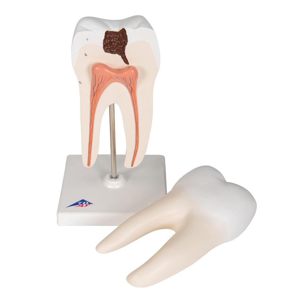 Lower Twin-Root Molar with Cavities Human Tooth Model, 2 Part