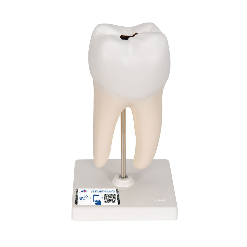 Lower Twin-Root Molar with Cavities Human Tooth Model, 2 Part