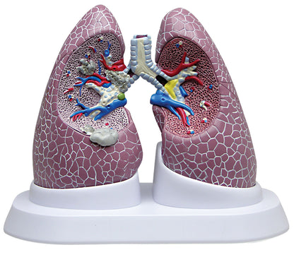 Model Lung Set With Pathologies