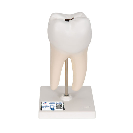 Lower Twin-Root Molar with Cavities Human Tooth Model, 2 Part