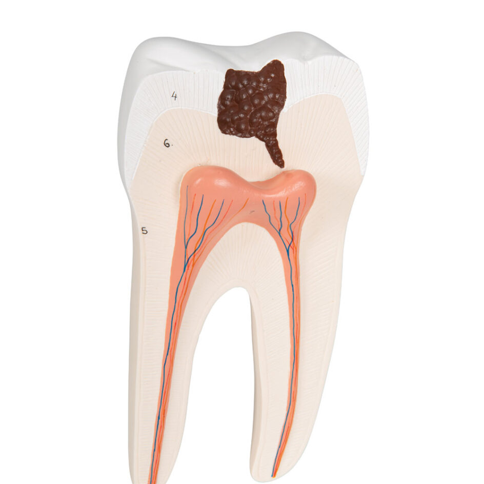 Lower Twin-Root Molar with Cavities Human Tooth Model, 2 Part | Delta ...